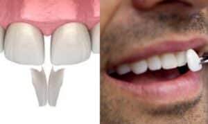 Comparison of dental veneers and bonding showing tooth shape and placement on a patient's smile.