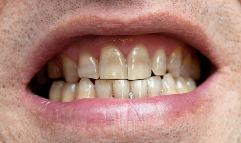 Close-up of discolored teeth showing tetracycline staining with yellow and brown streaks.