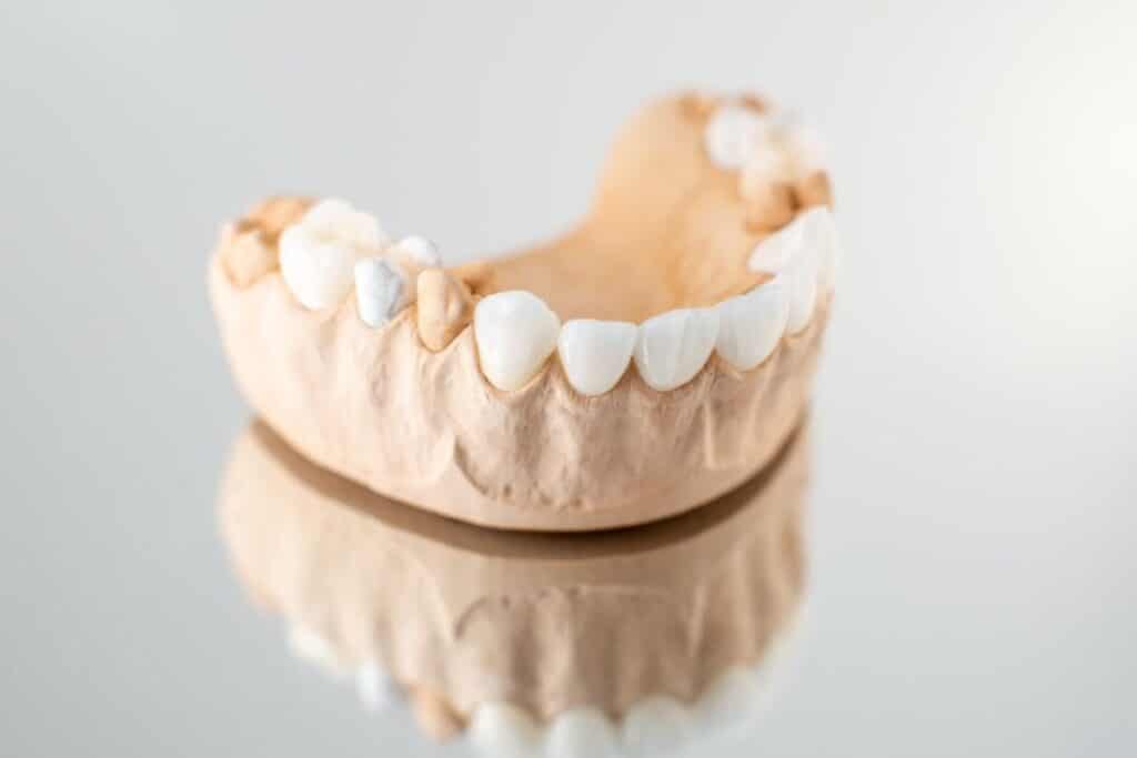 Dental model showing white porcelain veneers on front teeth for cosmetic dentistry demonstration.