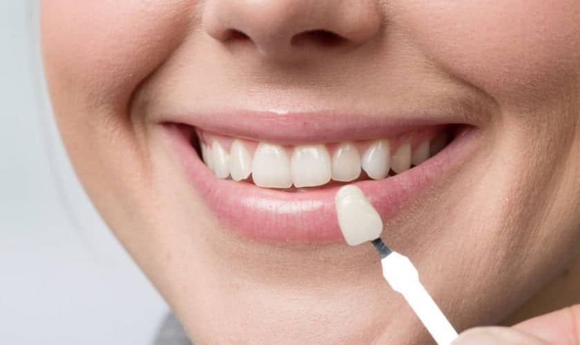 Woman displaying a bright white smile while holding a dental veneer shade guide to her lower lip.