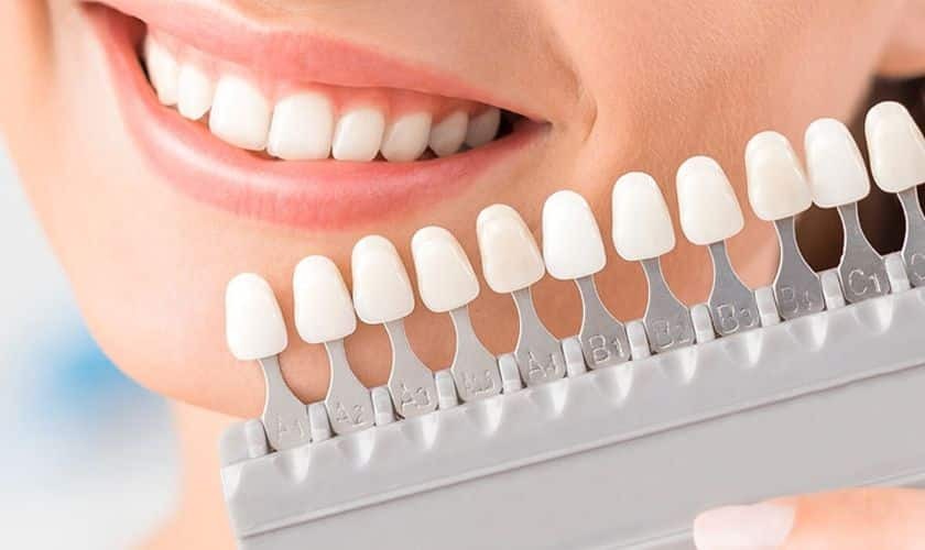 Smile comparison showing tooth shade guide with natural teeth next to veneer color samples.