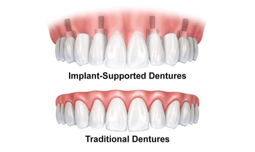 Implant-supported dentures compared to traditional dentures in Niceville, FL.