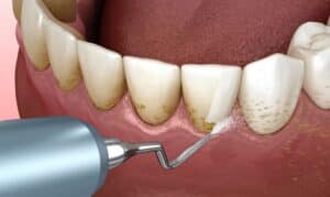 Ultrasonic scaling removes tartar and plaque buildup from tooth surfaces during periodontal treatment.