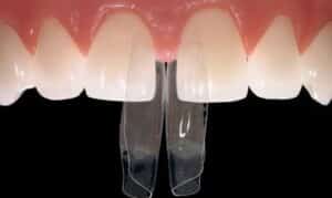Dental bonding veneers displaying tooth shade comparison for cosmetic smile enhancement.