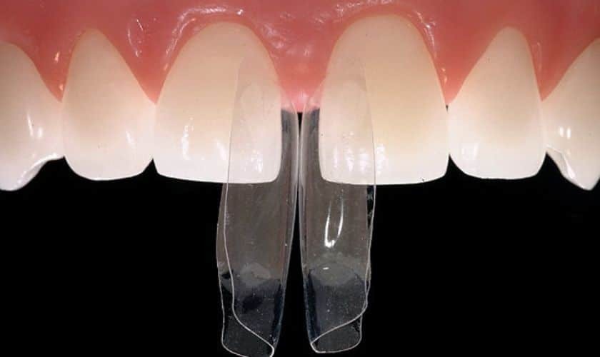 Dental bonding veneers displaying tooth shade comparison for cosmetic smile enhancement.