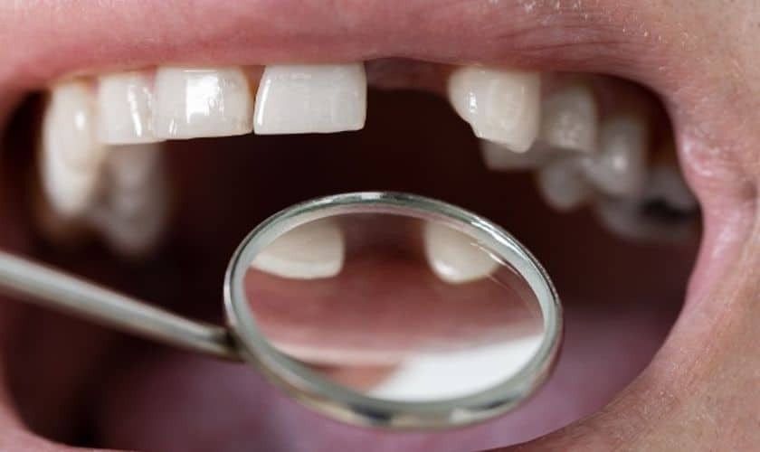 Dental mirror showing missing front teeth during oral examination.