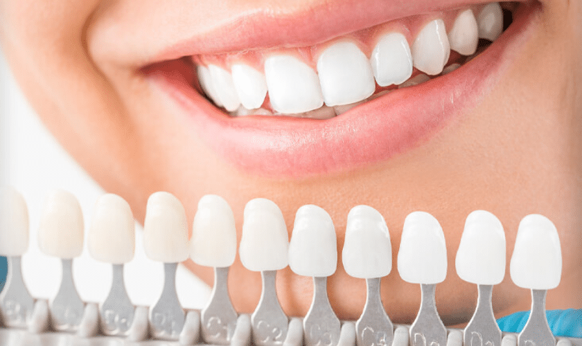 Woman displaying bright white teeth smile with shade guide showing cosmetic dentistry results.