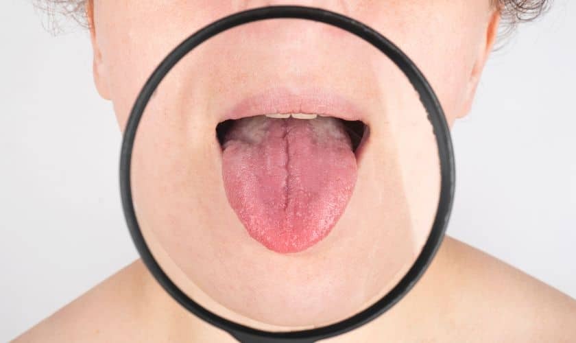 Close-up view of a patient's open mouth showing the tongue and oral cavity during dental examination.