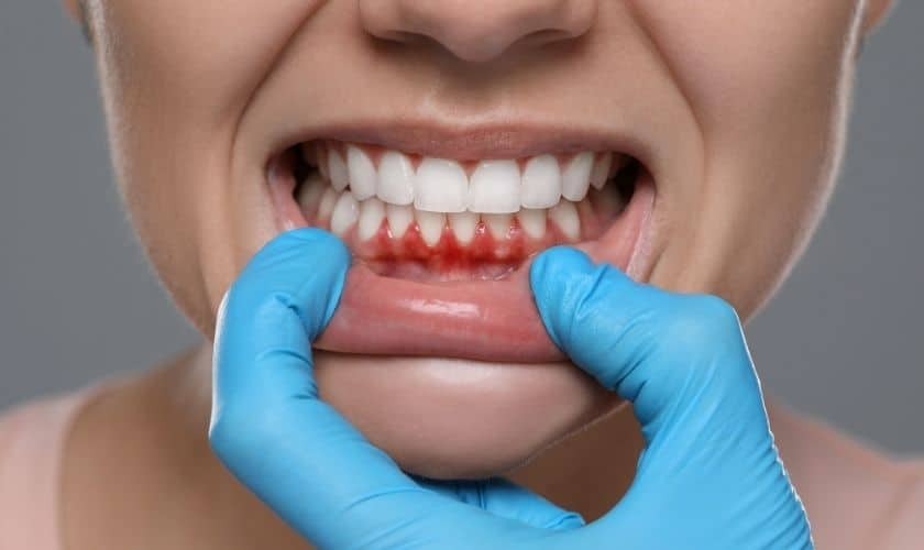 Close-up of inflamed gums showing signs of gum disease requiring dental treatment.