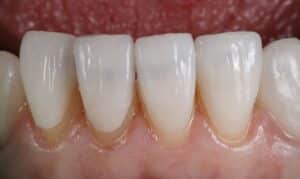 Close-up of four natural-looking bonded teeth showing smooth, white surfaces with proper contours in Niceville.