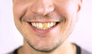 Man smiling showing results of cosmetic tooth bonding treatment in Niceville, FL.