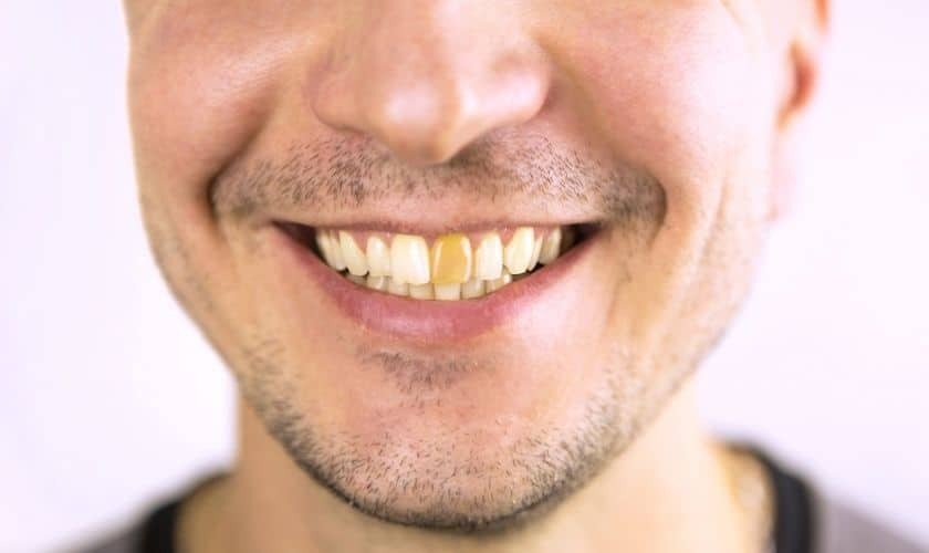 Man smiling showing results of cosmetic tooth bonding treatment in Niceville, FL.