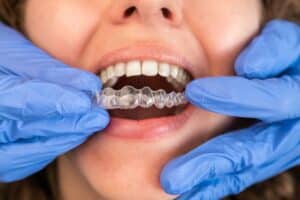 Dentist inserting clear Invisalign aligner tray into patient's mouth during orthodontic treatment.