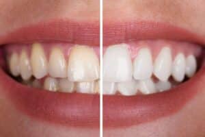 Before and after teeth whitening comparison showing yellowed teeth on left and brightened teeth on right.