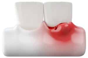 Inflamed gum tissue between two teeth showing signs of gum disease and bleeding.