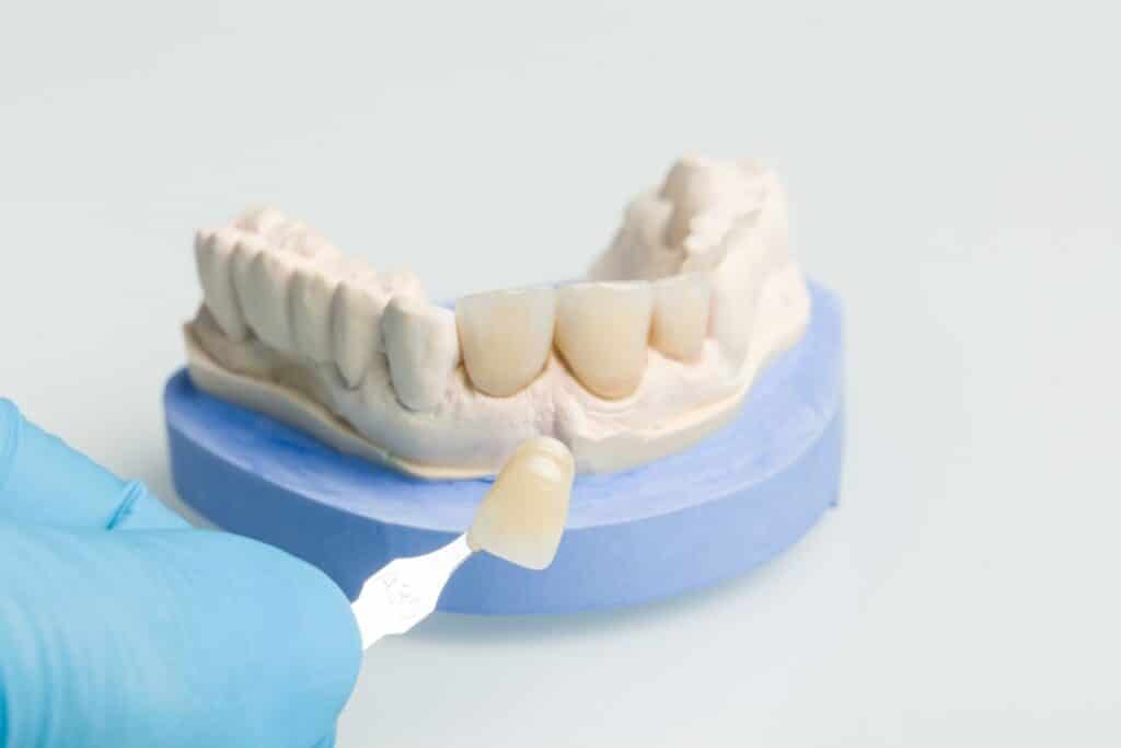 Dental veneer shade guide showing tooth-colored ceramic veneers on model for Niceville dental care.