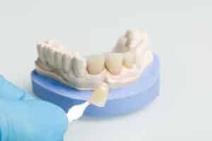 Dental veneer shade guide showing tooth-colored ceramic veneers on model for Niceville dental care.