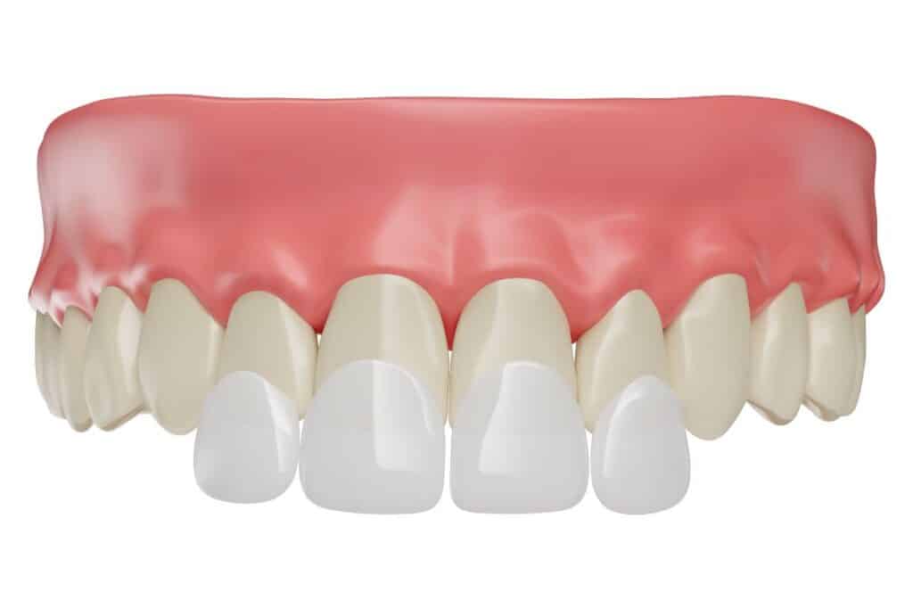 Dental veneer mockup showing white porcelain veneers on front teeth with natural gum line.