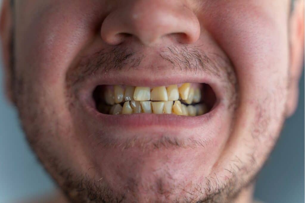 Before and after example showing severely stained and discolored teeth needing professional dental treatment.