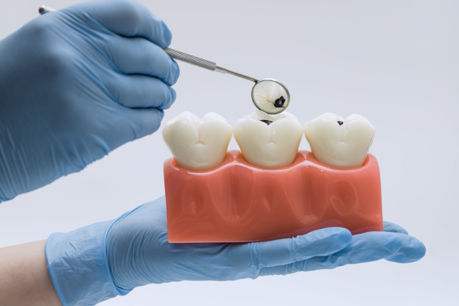 Dentist examining dental model showing three teeth with decay demonstration tool.