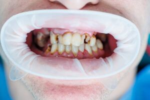 Close-up of severe dental staining and tartar buildup on upper front teeth showing alcohol damage effects.