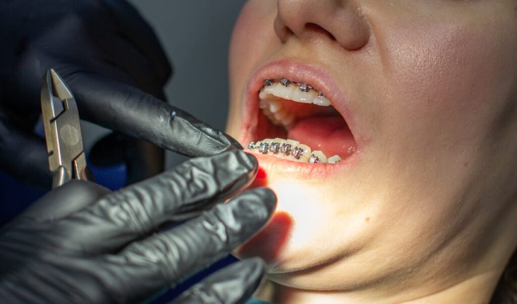 Dental Fillings in Niceville
